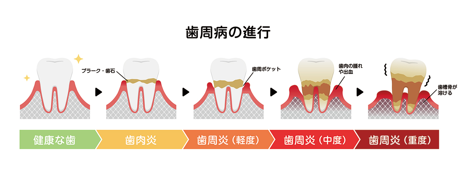歯周病を治療するメリット