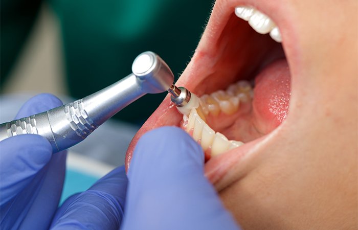 歯周基本治療