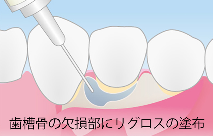 歯周病の外科治療
