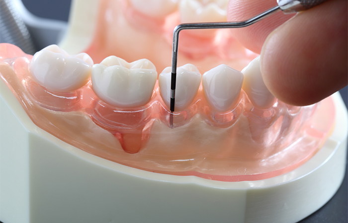 歯ぐきの検査とカウンセリング 